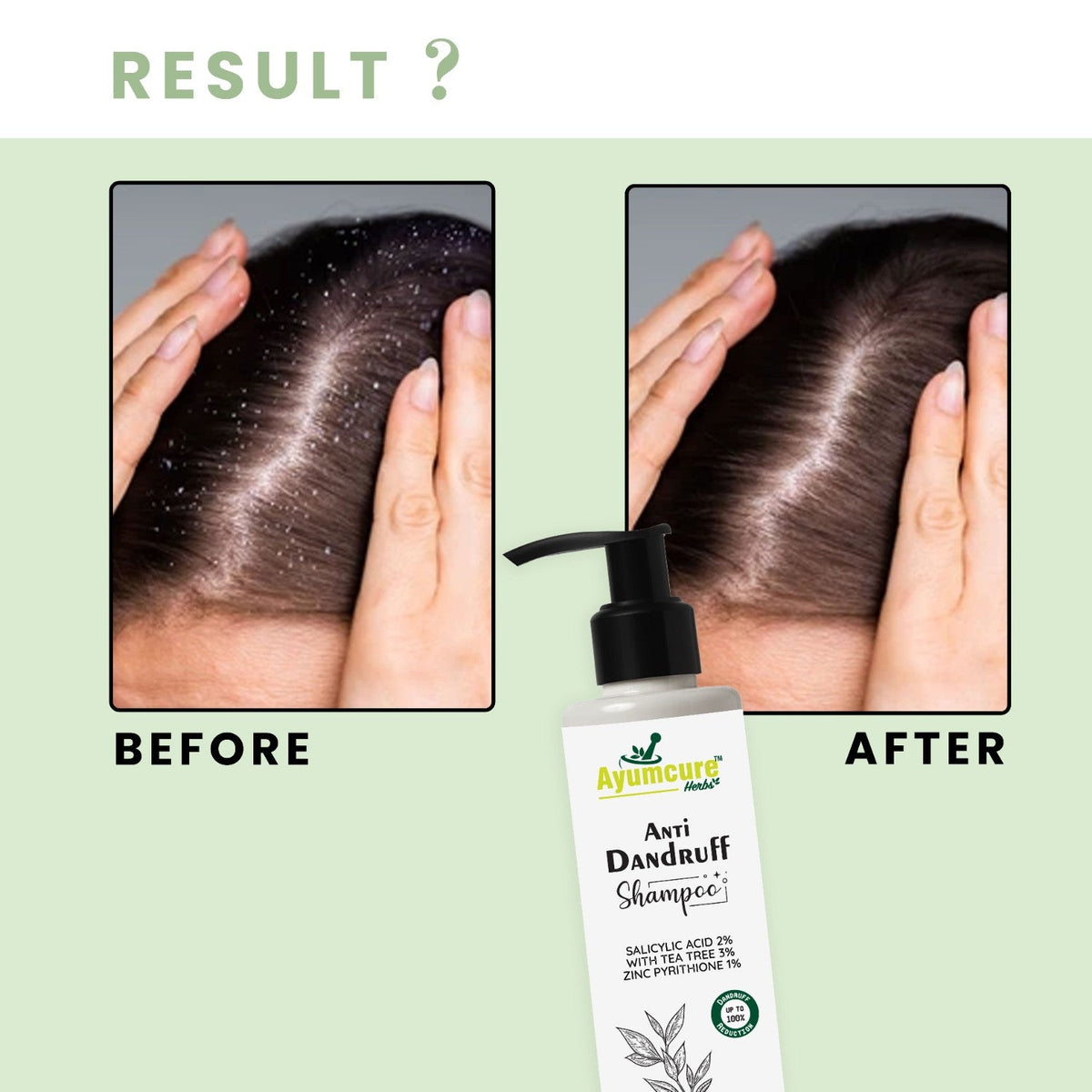 3% Tea Tree Anti-Dandruff Shampoo with 2% Salicylic Acid | Men & Women