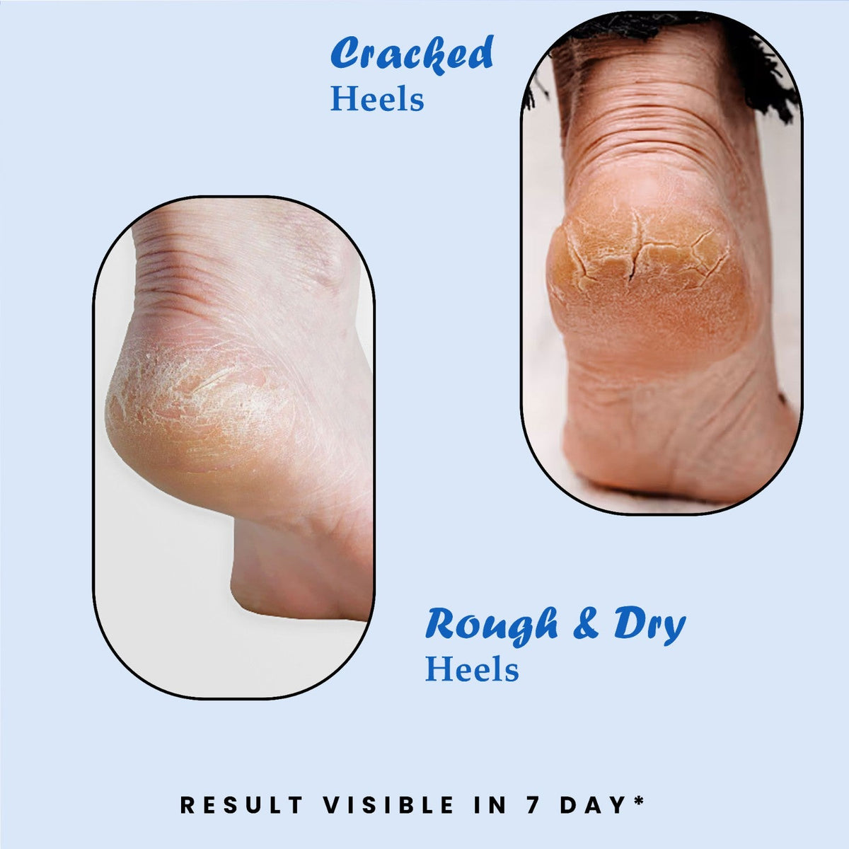 20% Urea Foot Care Roll-On Serum | Cracked Heels & Dry Skin | Men & Women