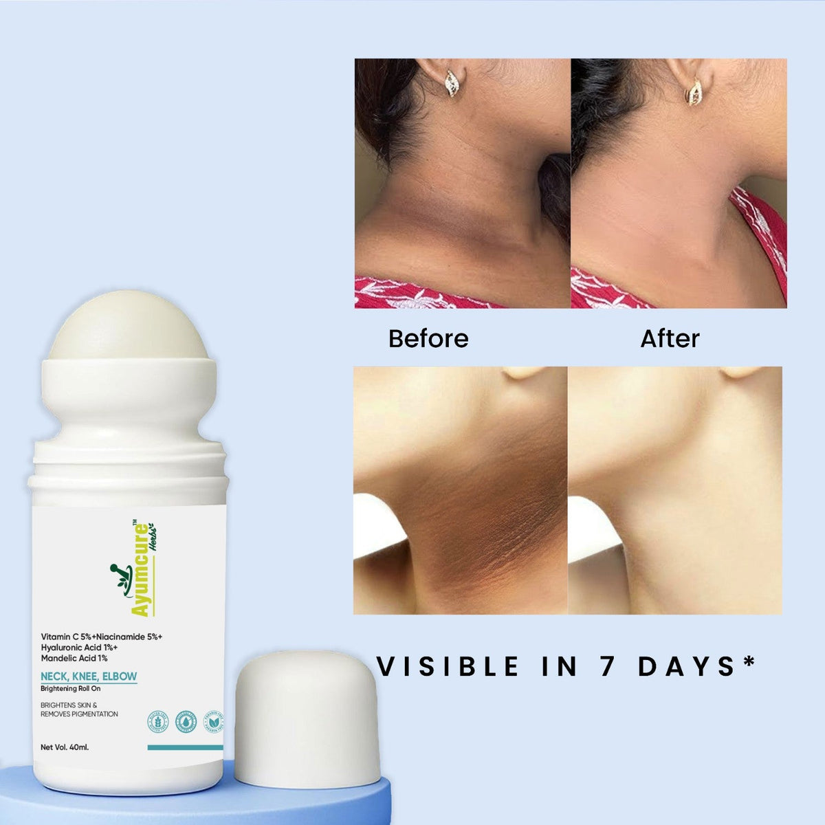 5% Niacinamide Roll-On – Fades Dark Spots on Neck, Knee & Elbow | All Skin Types