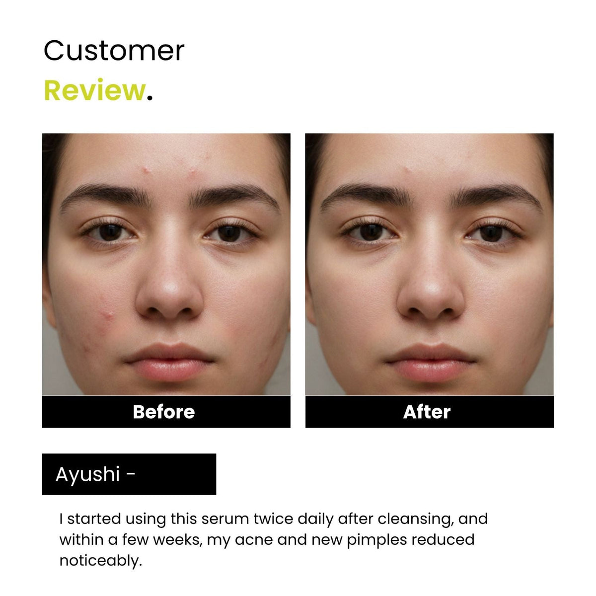 2% Salicylic Acid + 3% Niacinamide Serum | Acne, Blackheads & Dark Spots | Unisex