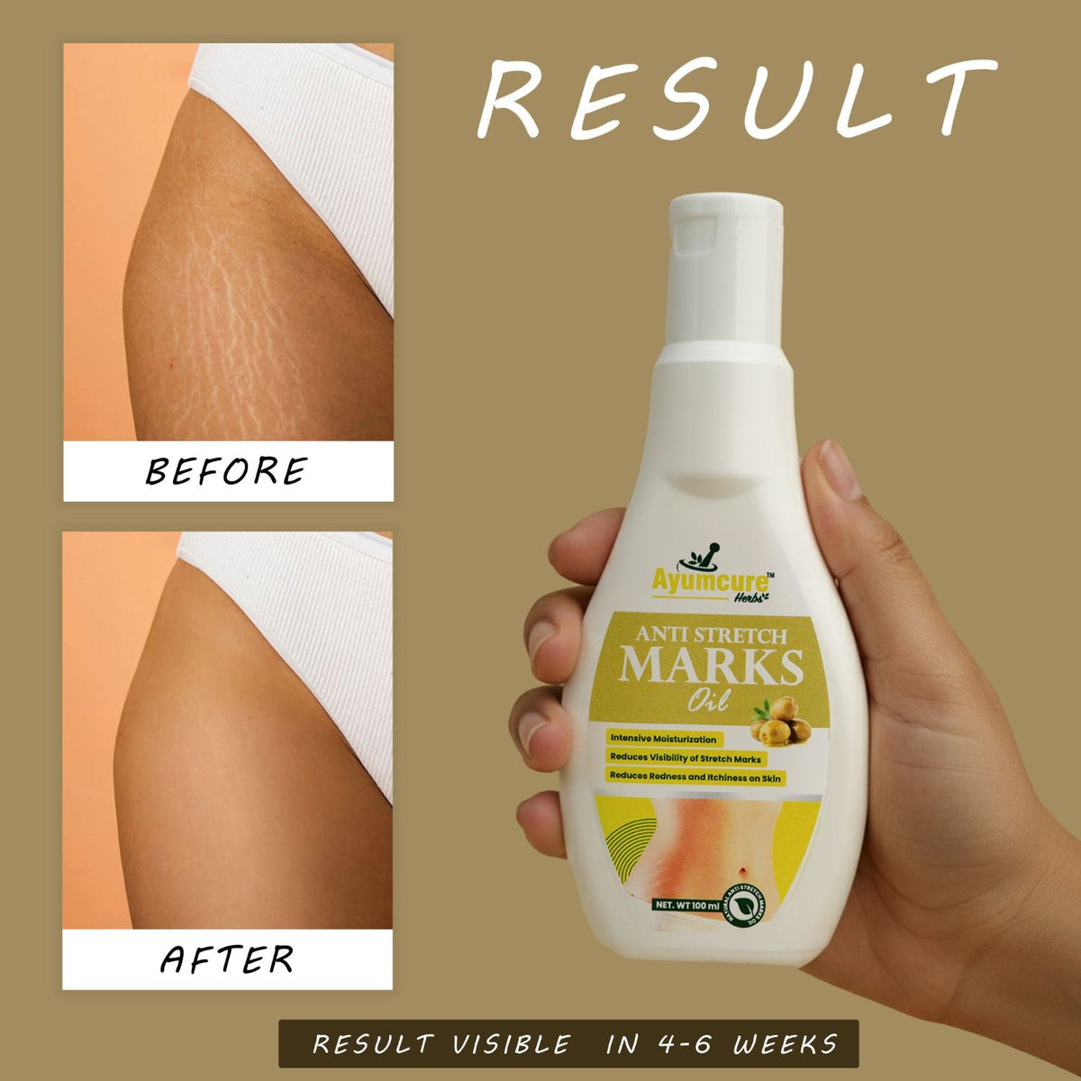 Stretch Mark Solution Oil | Scar Removal & Skin Elasticity | For Women